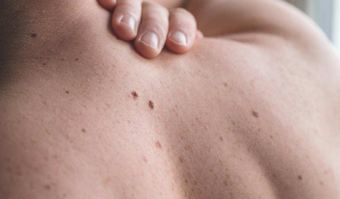 closeup of back with moles