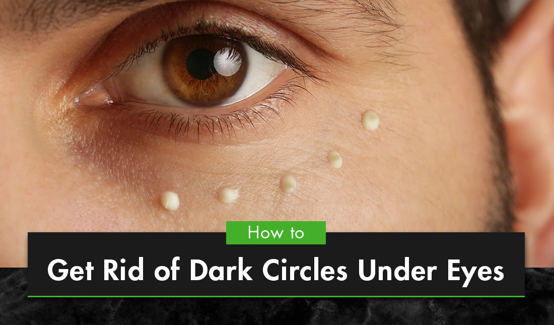 get rid of dark circles under eyes