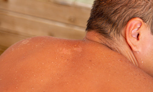 man with sunburned skin