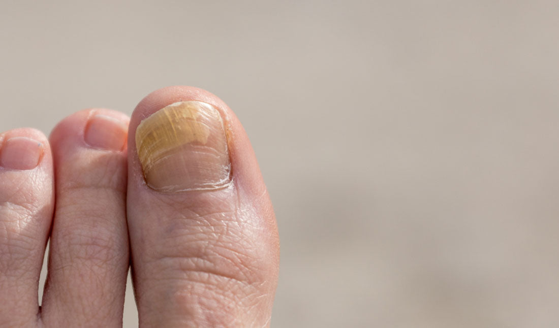 nail fungus on big toe