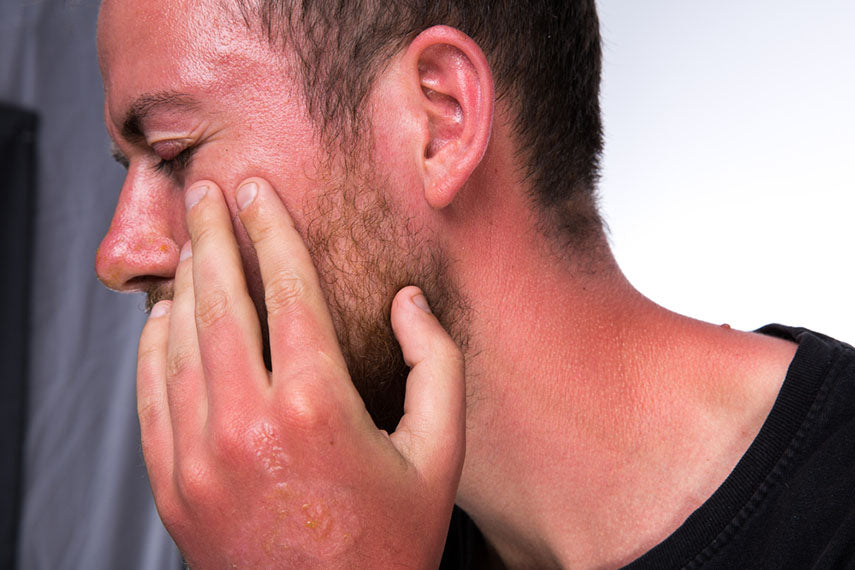 sun burn with swelling and blisters