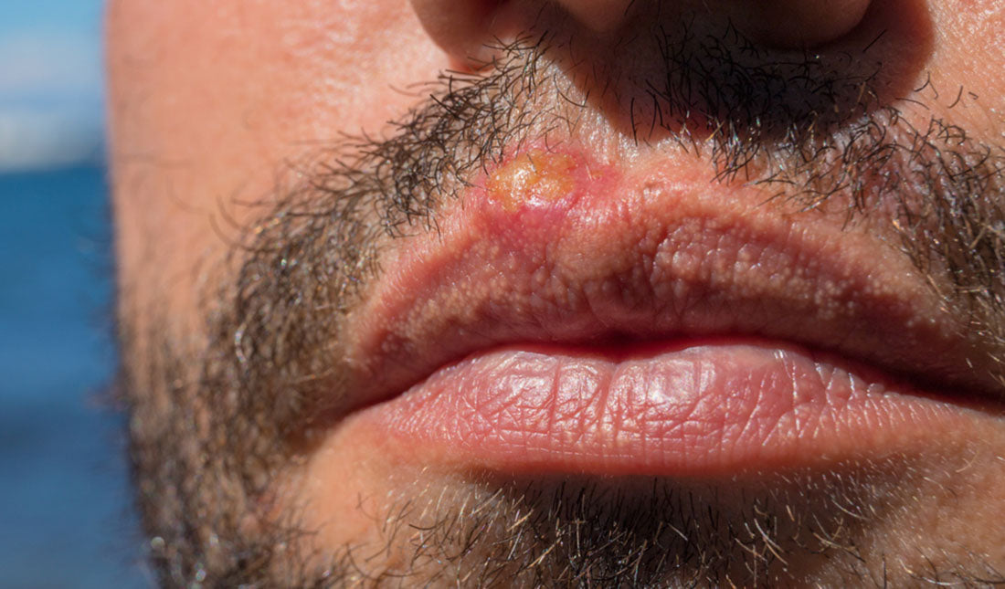 sunburn lips closeup