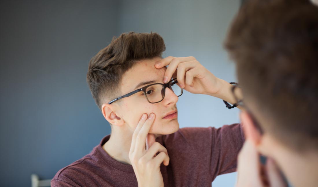 young man popping pimple